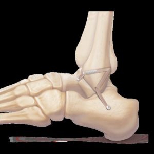 Diagram-representing-ankle-ligament-repair-300x300