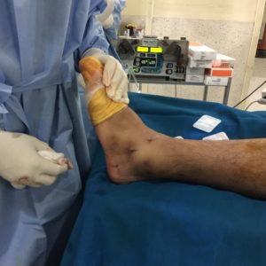Picture-showing-small-stitches-after-arthroscopic-ankle-ligament-repair-300x300