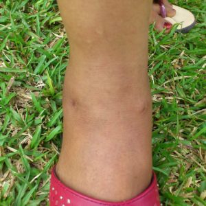 Small-scars-after-arthroscopic-ankle-arthrodesis-or-fusion-300x300