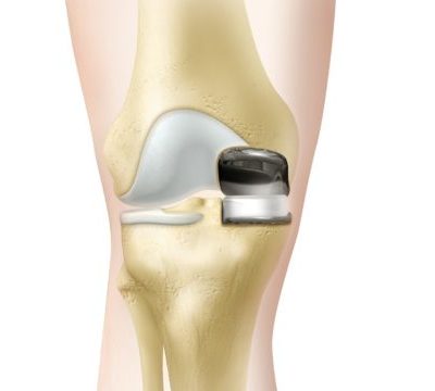 UNICOMPARTMENTAL-KNEE-REPLACEMENT-diagram-580x360
