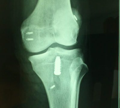 Xray-after-multiligament-surgery-–-ACL-MCL-580x360